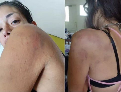 Se cansó de los golpes de su marido y mostró fotos de los moretones en redes